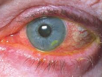 Eye infection