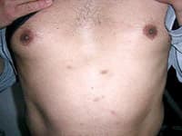 Clinical image related to Chaetomium mould infection