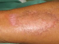 Clinical image related to Cladosporium mould infection