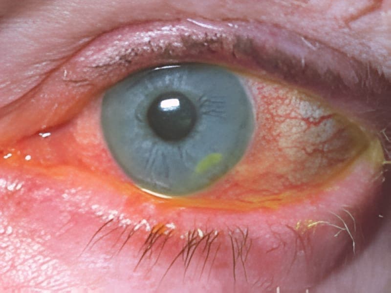 Eye infection associated with Fusarium mould