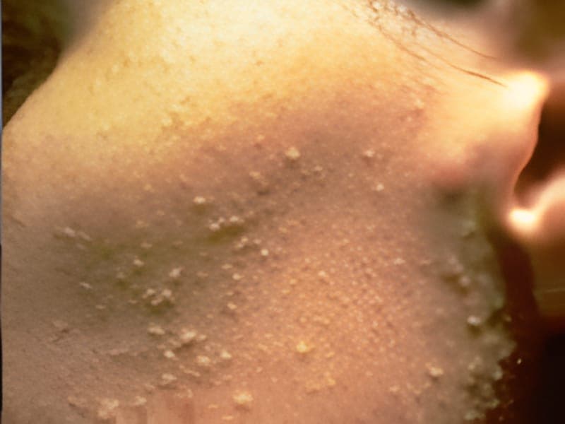 Clinical image related to Penicillium mould infection