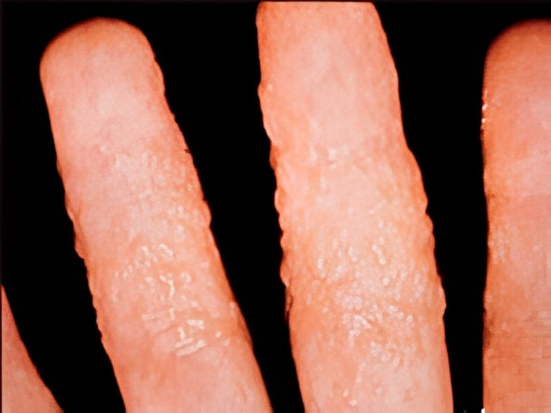 Clinical image related to Scopulariopsis mould infection