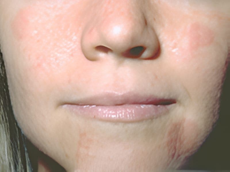 Clinical image related to Stachybotrys black mould