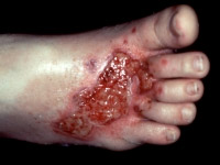 Mould infected foot